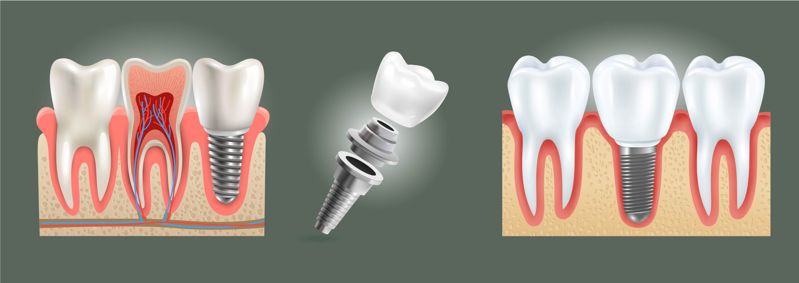 IMPLANTOLOGIA: scopriamo questa branca dell’odontoiatria