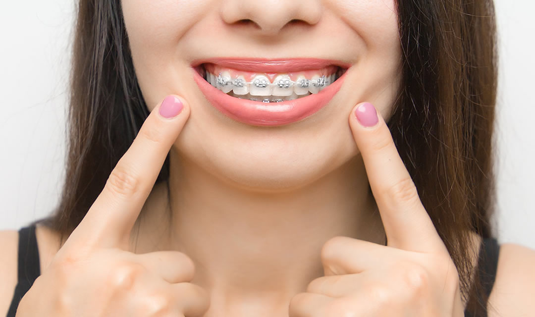 Cos’è l’Ortodonzia?